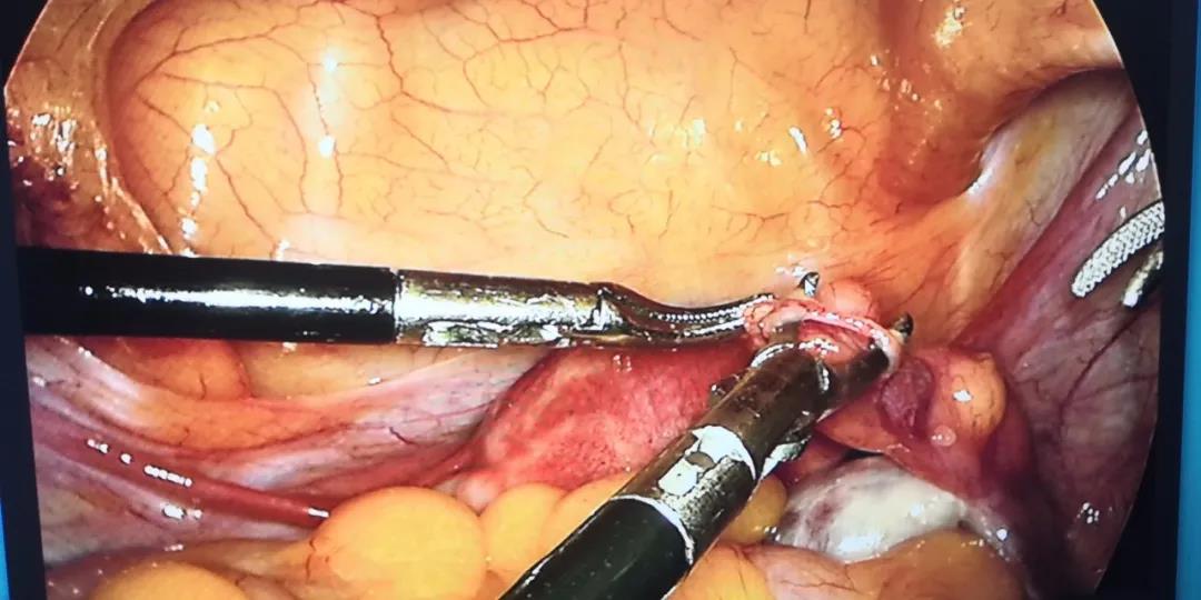 <b>宫腹腔镜联合手术，治疗不孕免开刀</b>